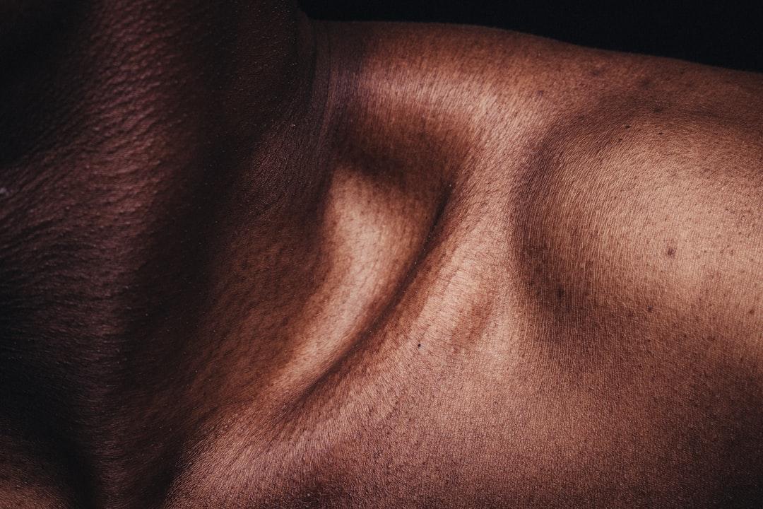 Mụn không còn là nỗi sợ 