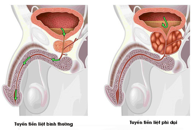 U xơ tuyến tiền liệt - nỗi lo của nam giới tuổi luống tuổi - Ảnh 1. U xơ tuyến tiền liệt - nỗi lo của nam giới tuổi trung niên - Ảnh 1.