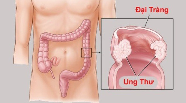 Làm sao để phát hiện và chẩn đoán sớm ung thư đại - trực tràng - Ảnh 1. Làm sao để phát hiện và chẩn đoán sớm ung thư đại - trực tràng - Ảnh 1.