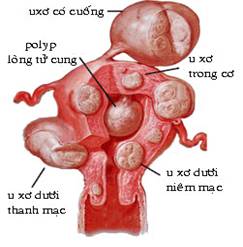 Bệnh học U xơ tử cung